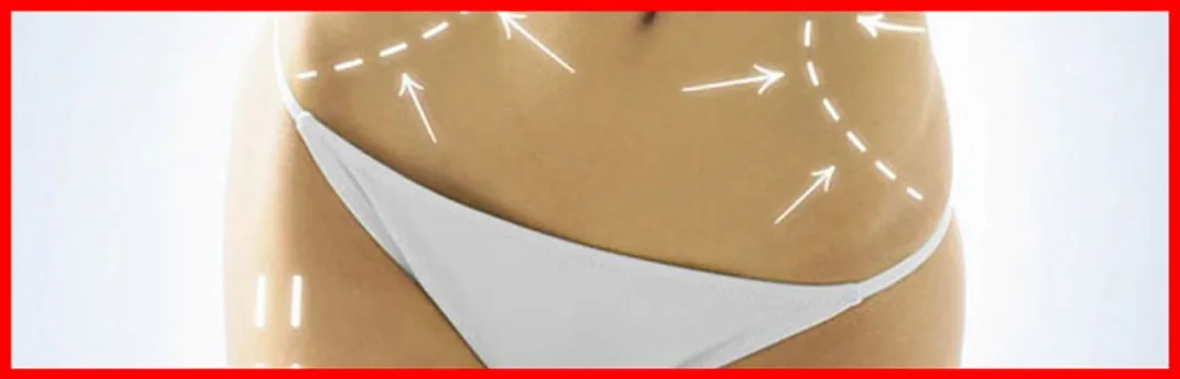 tratamientos efectivos para la celulitis